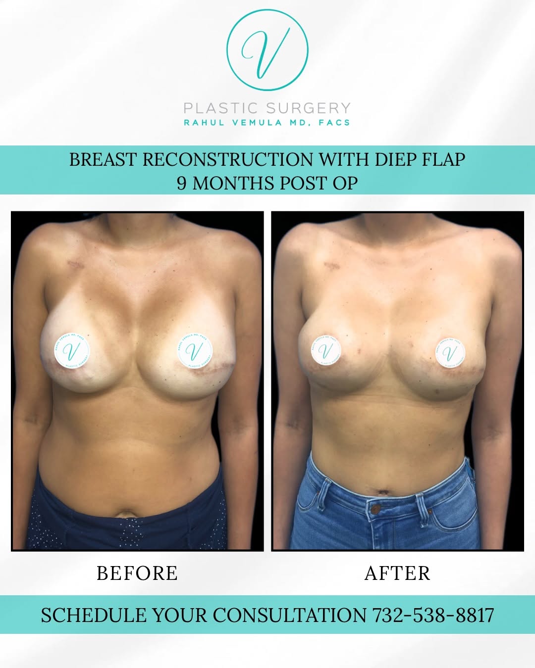 Instagram post by Dr. Rahul Vemula: Natural Tissue Reconstruction From implant-based reconstruction to a result that feels more natural. 🤍 After undergoing a mastectomy and im…