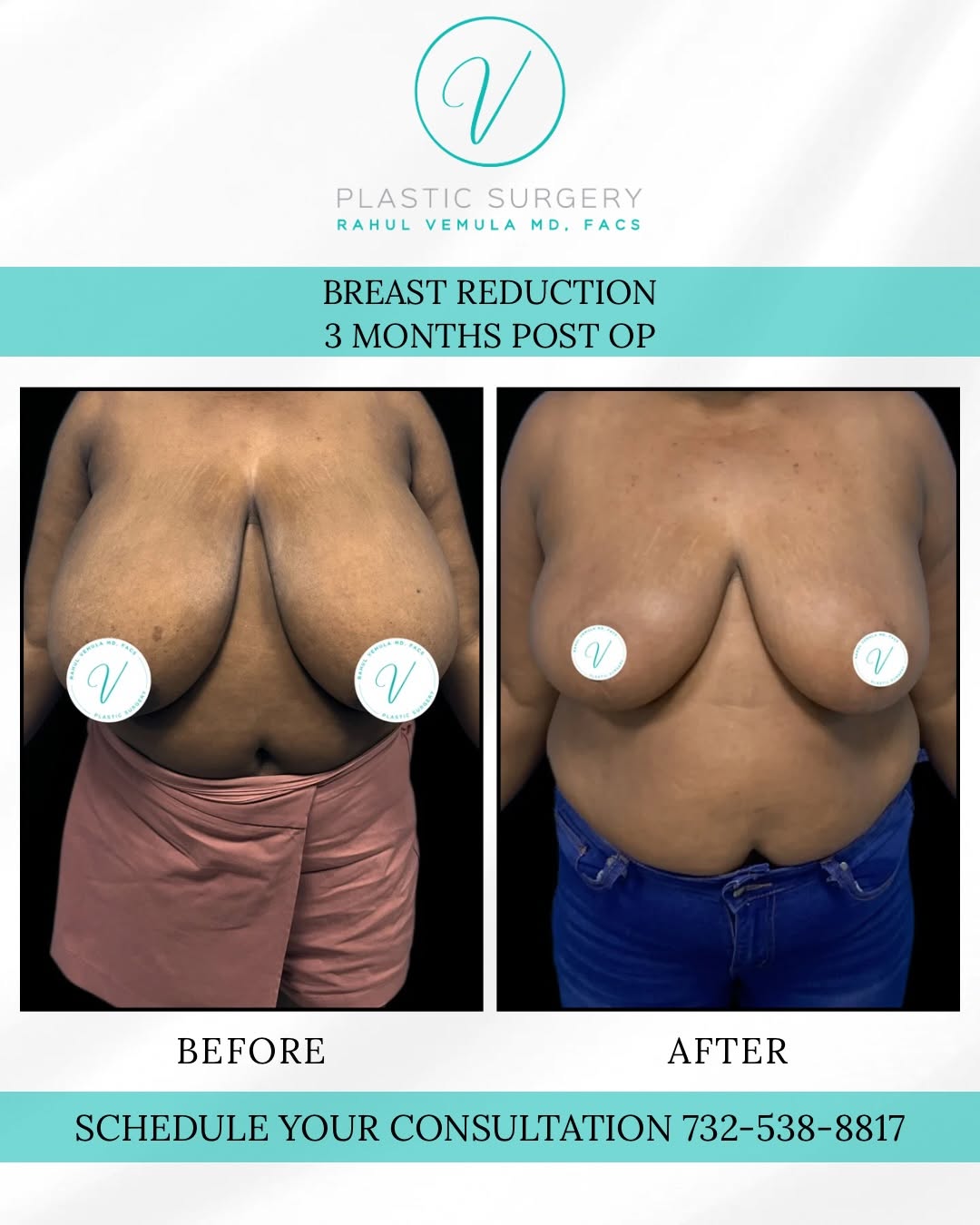 Instagram post by Dr. Rahul Vemula: If you’re struggling with chronic back, neck, or shoulder pain from heavy breasts, your search bar probably looks a lot like this: 🔍 “Will …