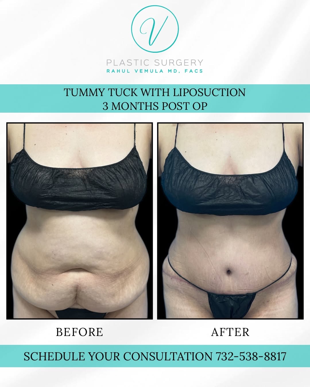 Instagram post by Dr. Rahul Vemula: ✨ Abdominoplasty + Core Liposuction | 3-Month Result ✨ After three pregnancies, this 42-year-old patient wanted to address abdominal fullnes…