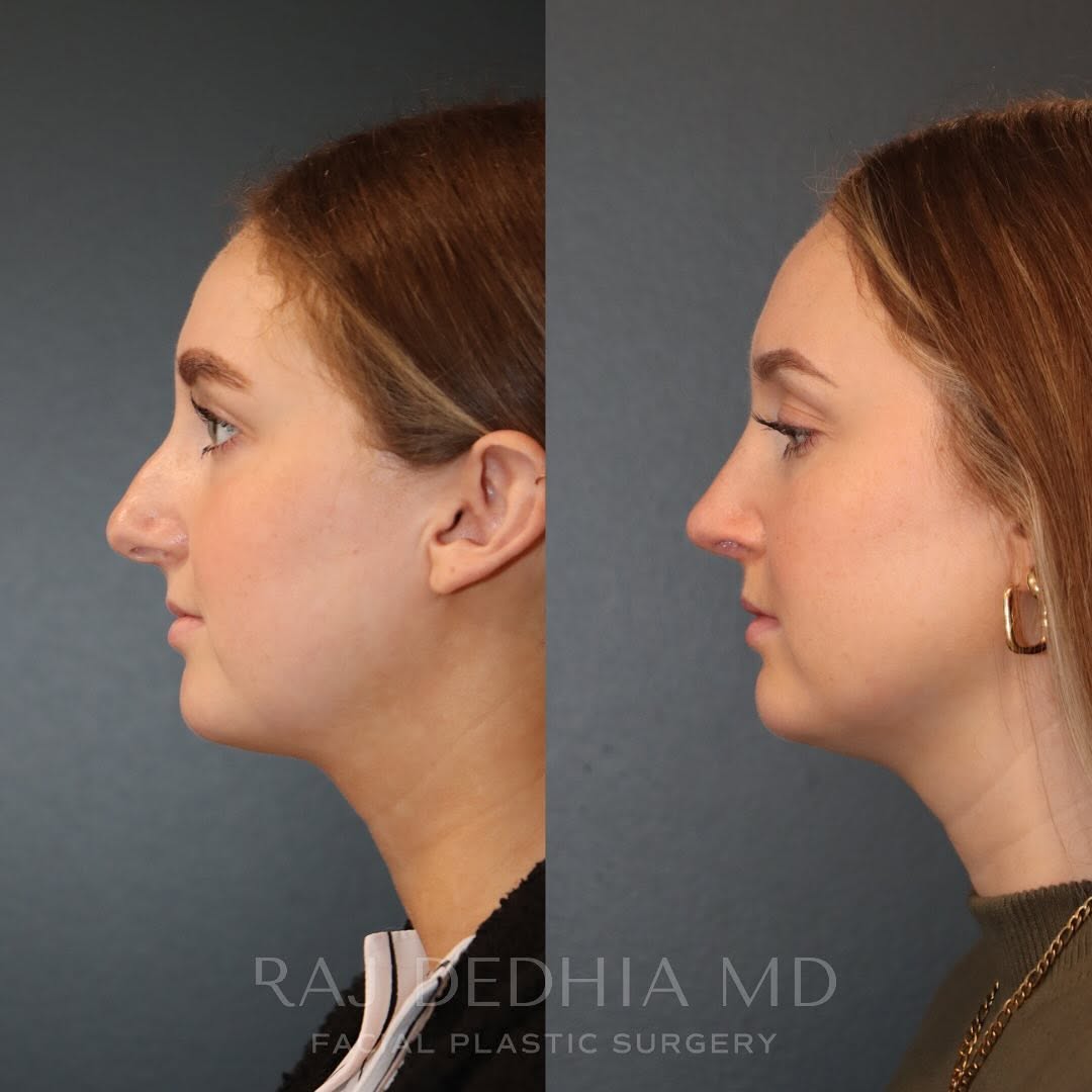 Instagram post by Dr. Raj Dedhia: Elegant, refined, and natural! We are thrilled to share this 1-year #rhinoplasty before and after on our stunning patient! You can see the f…