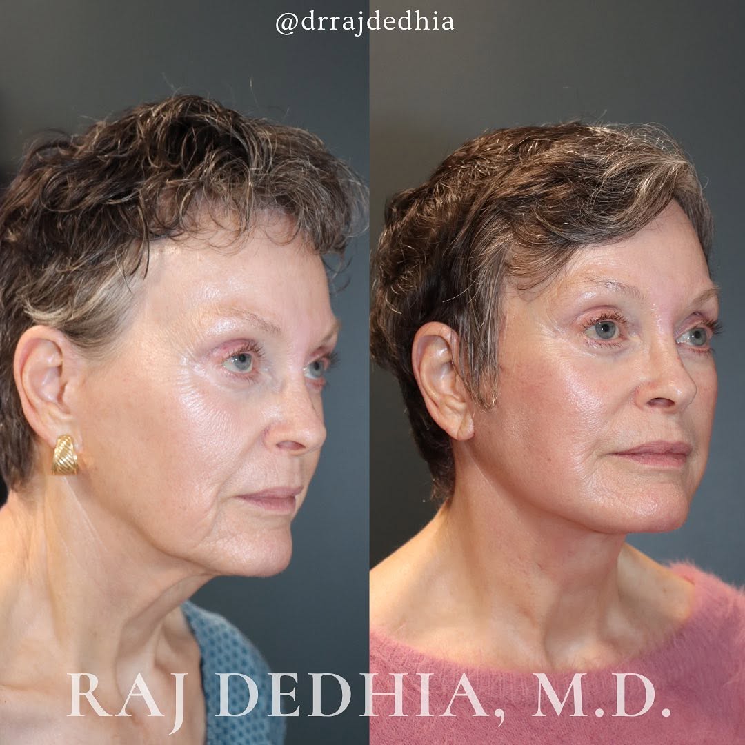 Instagram post by Dr. Raj Dedhia: Deep Plane Face and Neck Lift My 70 year old patient is looking amazing just 3 months after a #deepplane #facelift and #necklift. She is so …