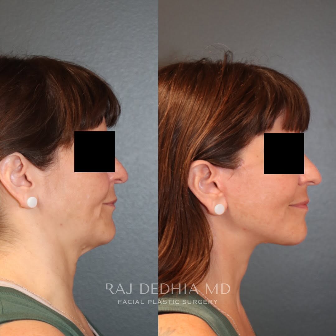 Instagram post by Dr. Raj Dedhia: Deep plane facelift/necklift This wonderful patient in her 40s underwent a deep plane face and neck lift. Here are her results at 6 months. …