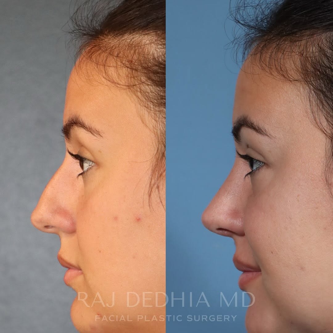 Instagram post by Dr. Raj Dedhia: Rhinoplasty - 1 year post-op This patient underwent rhinoplasty to address a prominent dorsal hump, a poorly defined tip, a deviated nasal a…