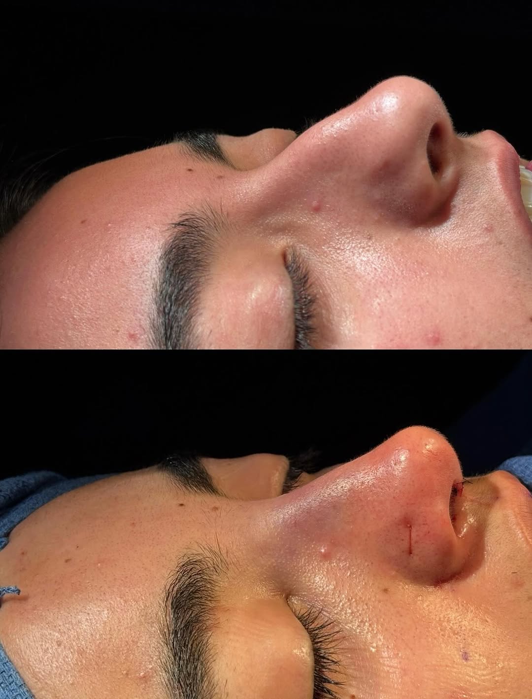 Instagram post by Dr. Raj Dedhia: On-table rhinoplasty result showing a more refined tip, less nostril show and dorsal changes customized to the patient’s aesthetic goals. Th…