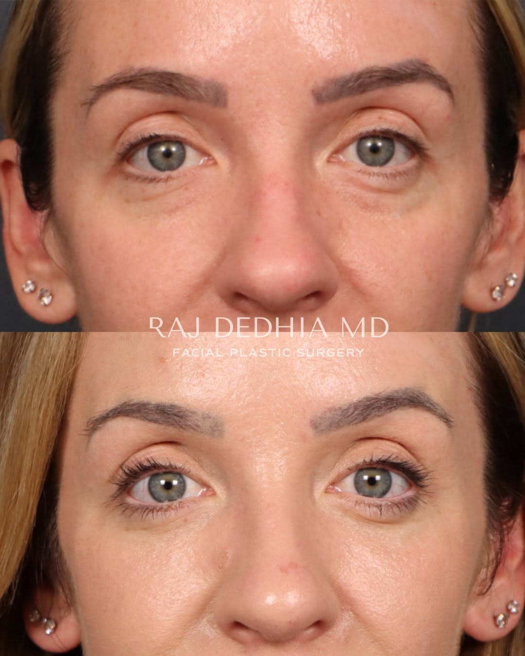 Instagram post by Dr. Raj Dedhia: Lower eyelid surgery This patient underwent a lower blepharoplasty, facial fat transfer, and fractional CO₂ laser resurfacing to address und…