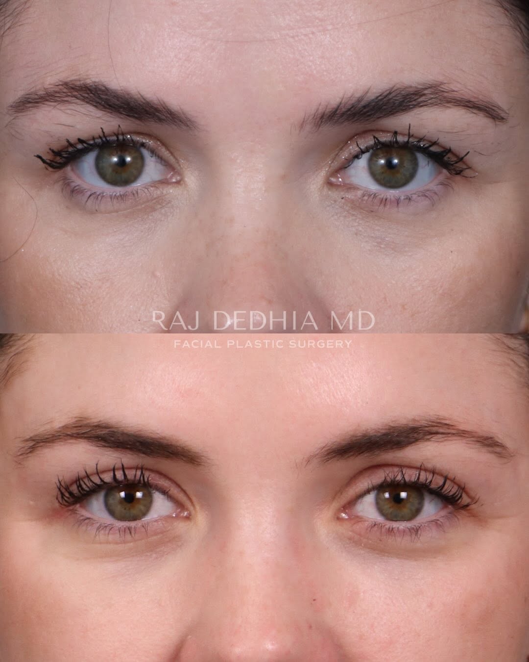 Instagram post by Dr. Raj Dedhia: Upper blepharoplasty (“upper eyelid lift”) to treat hooded upper eyelids and restore a more refreshed appearance. A subtle change that can m…