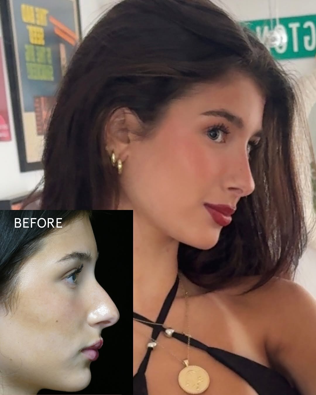 Instagram post by Dr. Raj Kanodia: Transformation timeline: Before ➝ Cast reveal at 7 days ➝ 3 weeks post-op!