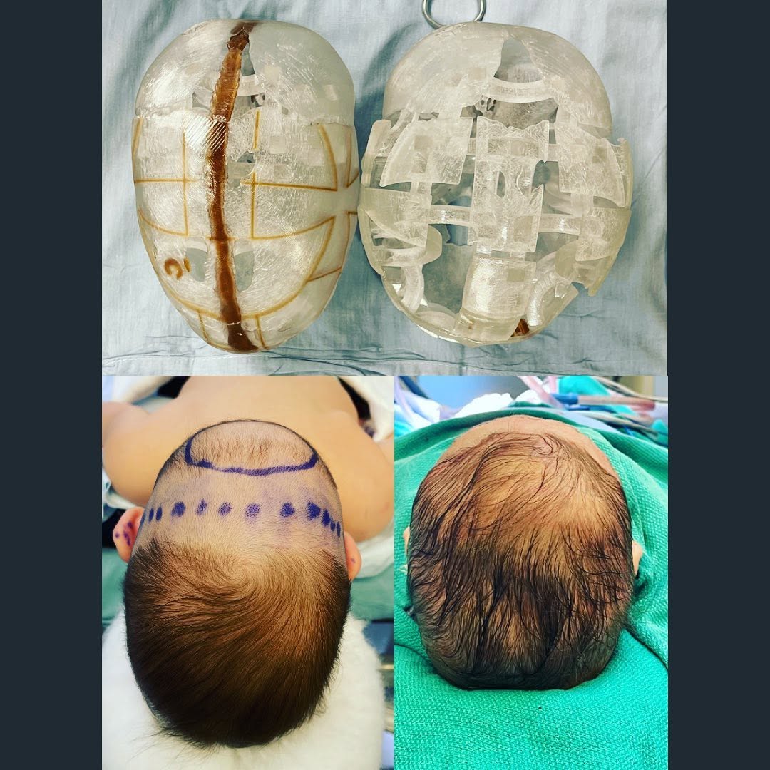 Instagram post by Dr. Raj Sawh-Martinez: Craniosynostosis (krei-nee-ow-suh-naaz-tow-suhs) is a premature fusion of the cranial bones and one of the scariest diagnosis our families f…