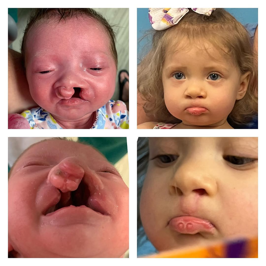 Instagram post by Dr. Raj Sawh-Martinez: Update on this cuties evolution. #cleftstrong ❤️💪🏽 The family wanted to keep her lip pits as it’s a family trait. She’s growing nicely int…