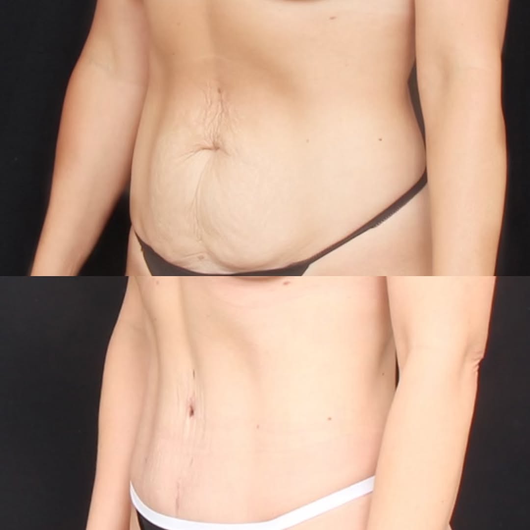 Instagram post by Dr. Raja Mohan: A flatter, tighter abdomen with improved contour and definition — while keeping the result natural, proportionate, and balanced. 🙌 A tummy …