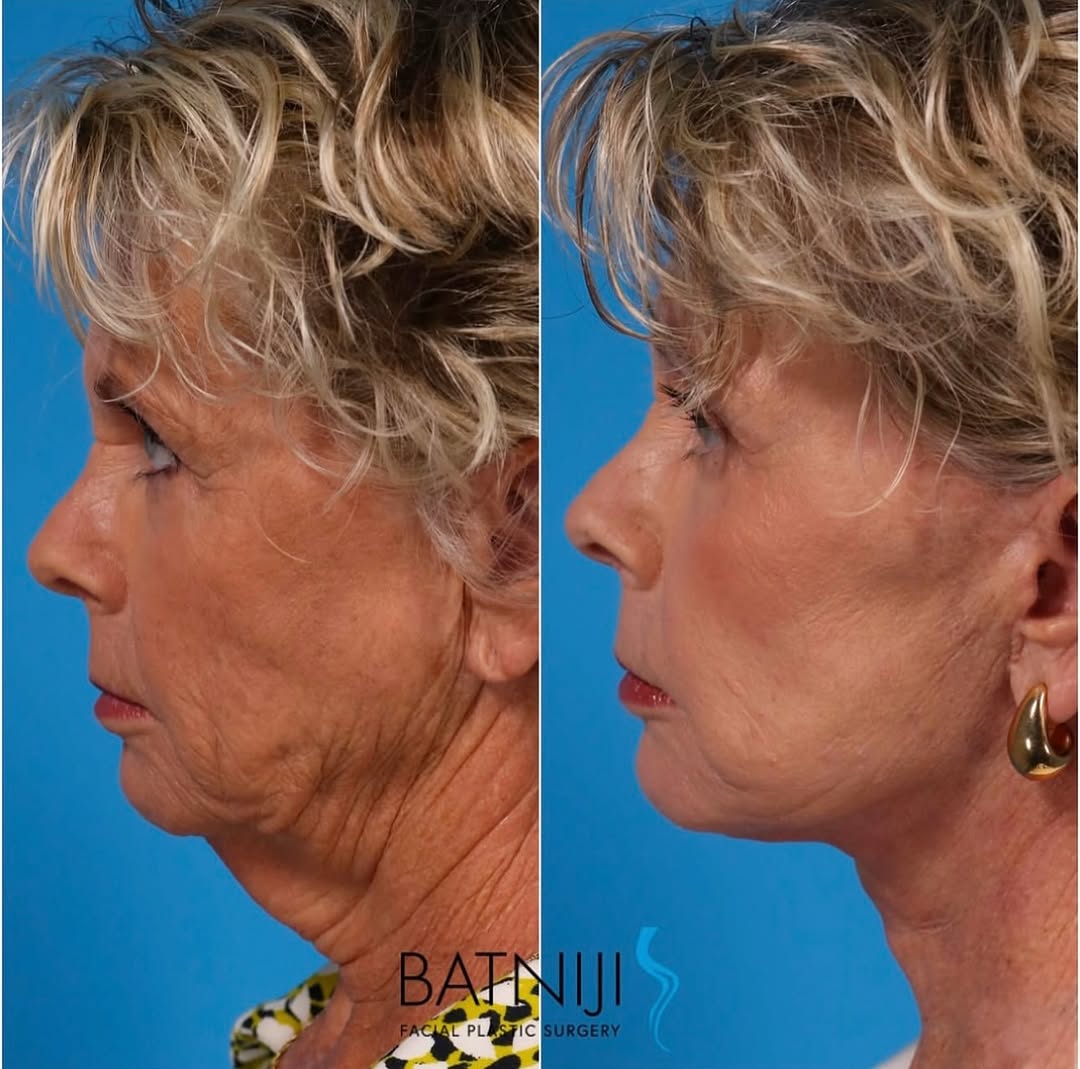 Instagram post by Dr. Rami K. Batniji: 🔹 Before & After: 🔹 Lower Facelift / Necklift 🔹 Endoscopic Brow Lift 🔹 Laser Skin Resurfacing ☎️ (949) 650-8882 📍 Newport Beach + Bever…