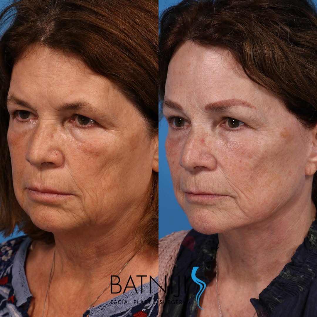 Instagram post by Dr. Rami K. Batniji: 🔹 Before & After: 🔹 Lower Facelift / Necklift 🔹 Endoscopic Brow Lift ☎️ (949) 650-8882 📍 Newport Beach + Beverly Hills . . . #plasticsur…