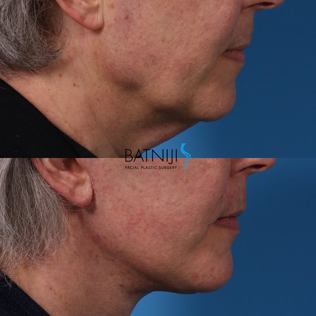 Instagram post by Dr. Rami K. Batniji: 🔹 Before & After: 🔹 Lower Facelift / Necklift ☎️ (949) 650-8882 📍 Newport Beach + Beverly Hills . . . #plasticsurgery #facialplasticsurge…