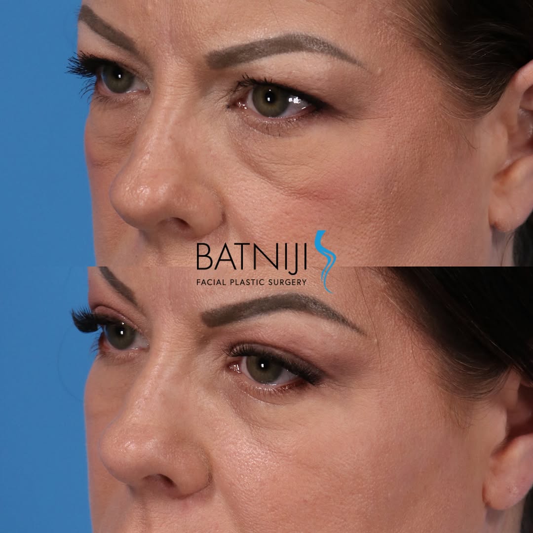Instagram post by Dr. Rami K. Batniji: 🔹 Before & After: 🔹 Lower Blepharoplasty (lower eyelid) ☎️ (949) 650-8882 📍 Newport Beach + Beverly Hills . . . #plasticsurgery #facialpl…