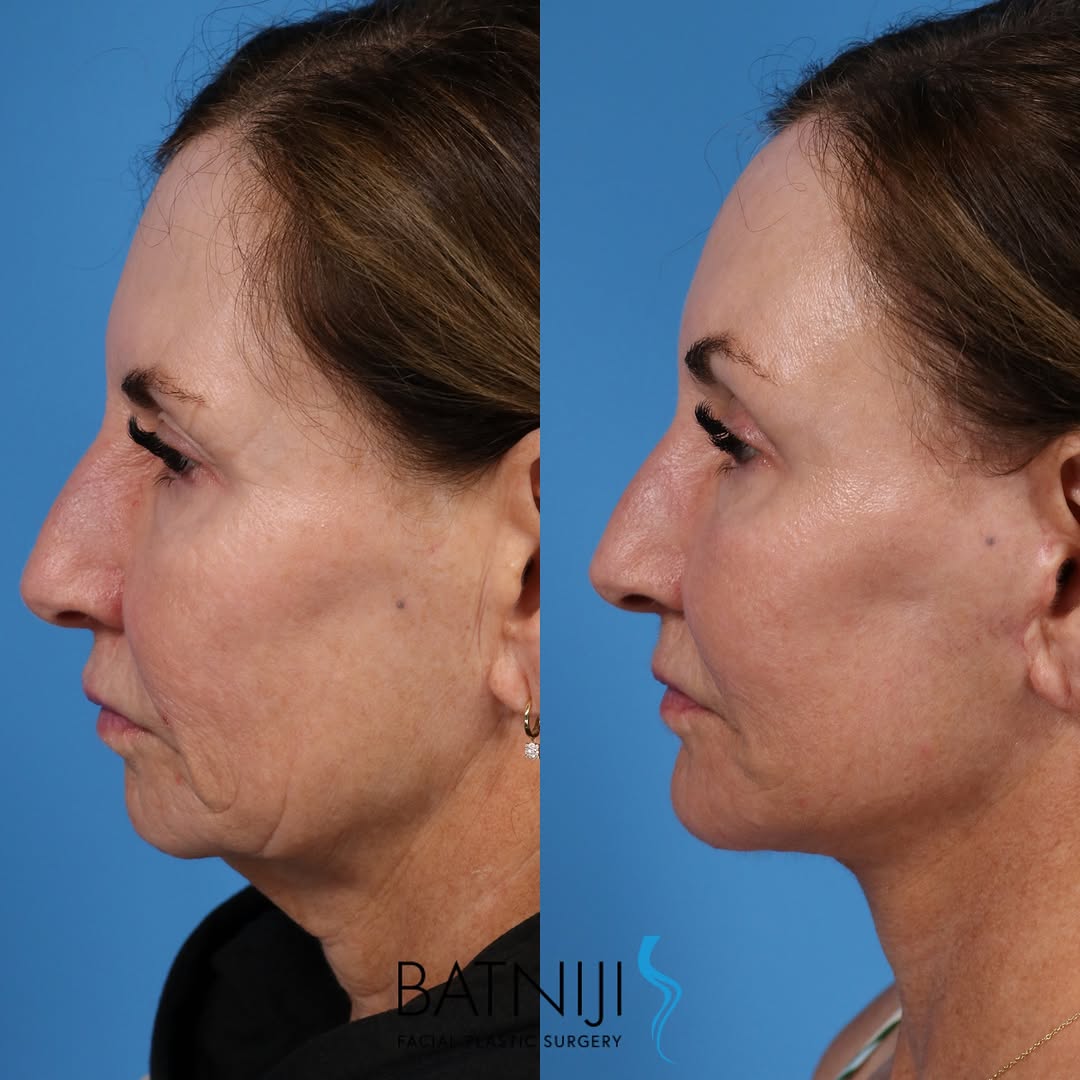 Instagram post by Dr. Rami K. Batniji: 🔹 Before & After: 🔹 Lower Facelift / Necklift 🔹 Chin Implant 🔹 Upper Bleph 🔹 Laser Skin Resurfacing ☎️ (949) 650-8882 📍 Newport Beach …