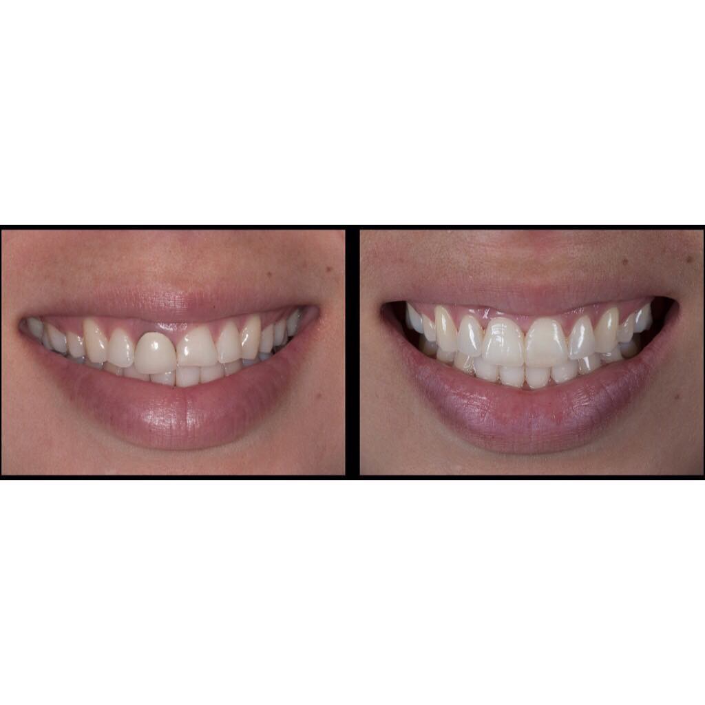 Instagram post by Dr. Ramin Mahallati: Using the latest, state of the art advancements in restorative dentistry, we are able to give our patients results like Martha's, shown in t…