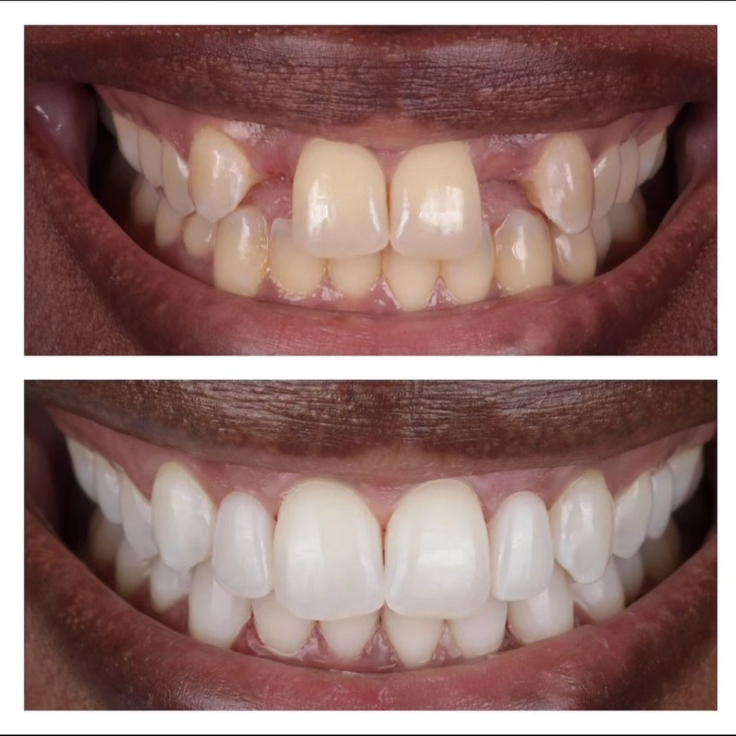 Instagram post by Dr. Ramin Mahallati: Resin bonded bridges are an excellent alternative to dental implants. Pontic sites were enhanced by doing a gum graft with Dr.Aalam @implant…