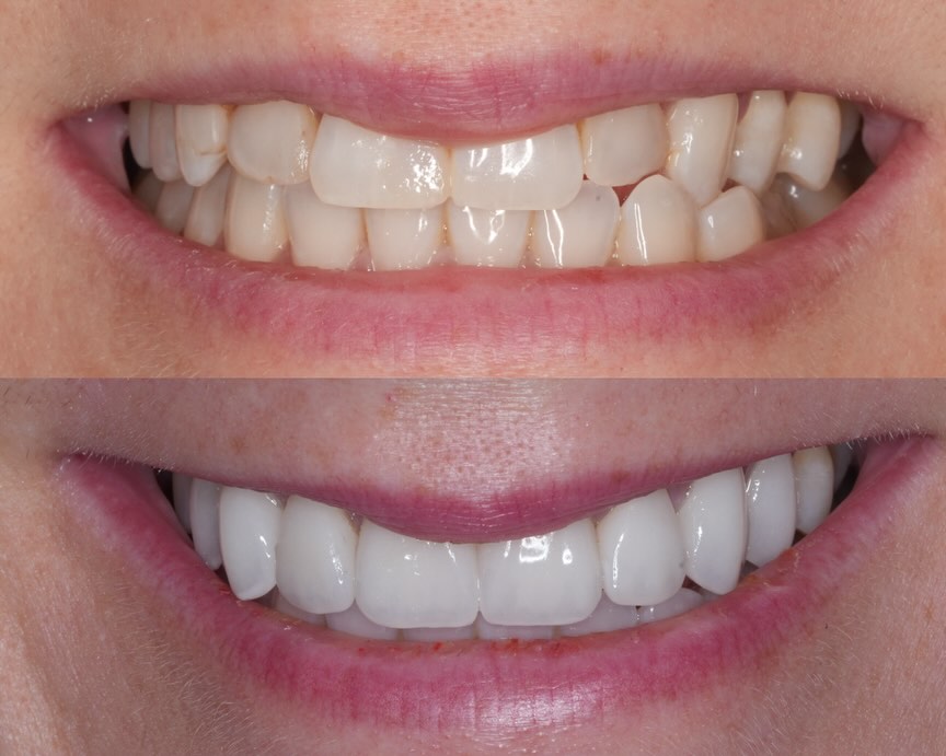 Instagram post by Dr. Ramin Tabib: Years of ortho and still in a crossbite