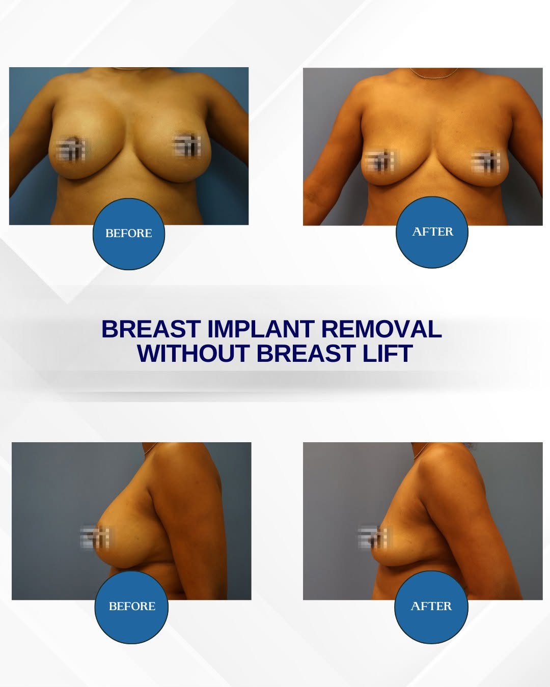 Instagram post by Dr. Ramiro Morales, Jr.: ➡️ Breast implant removal without a breast lift ⬅️ Natural results tailored to your goals. 💫 Learn more about your options with Dr. Ramiro …