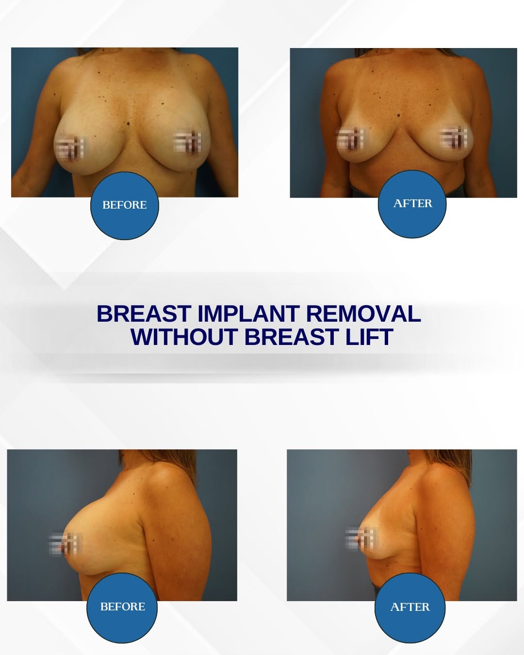 Instagram post by Dr. Ramiro Morales, Jr.: ➡️ Breast implant removal without a breast lift ⬅️ Natural results tailored to your goals. 💫 Learn more about your options with Dr. Ramiro …