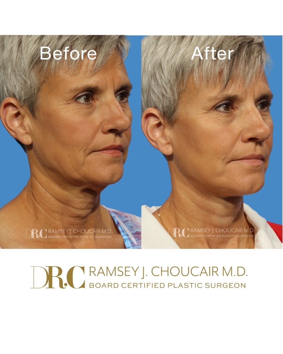 Instagram post by Dr. Ramsey J. Choucair: A refreshed, more defined appearance can continue to look natural and beautiful well beyond the initial recovery period. This 59-year-old…