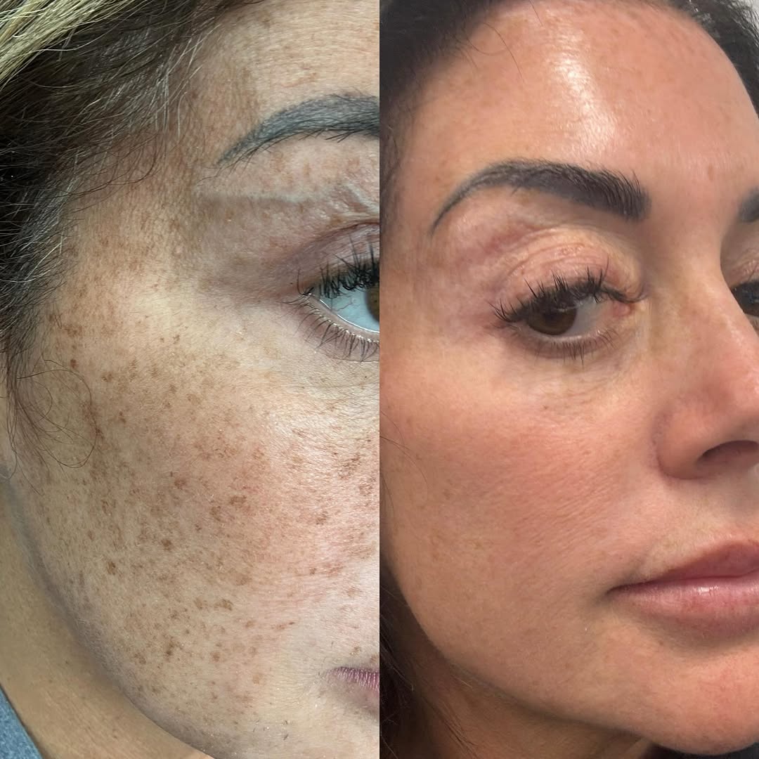 Instagram post by Dr. Ramtin Kassir: Fall booking is officially open for CO2 Fractional Laser.. and it’s the treatment worth planning around. This resurfacing laser requires rea…