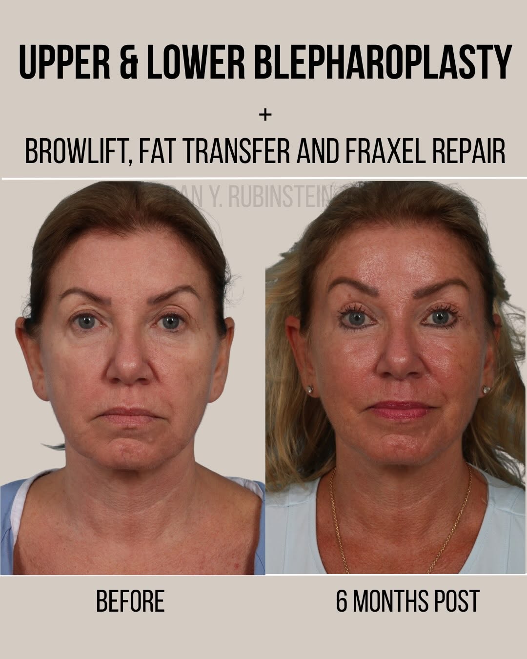 Instagram post by Dr. Ran Y. Rubinstein: 6 months post-op from a full-facial rejuvenation incorporating a brow lift, upper and lower blepharoplasty, structural fat transfer, and ful…
