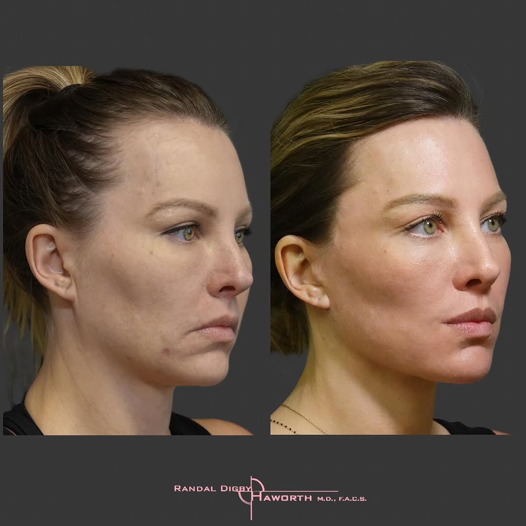 Instagram post by Dr. Randal Haworth: What is Future Proofing?🔮 I am asked all the time, “Isn’t he/she/ aren’t they too young to get a facelift”? My answer to that is no, simply…