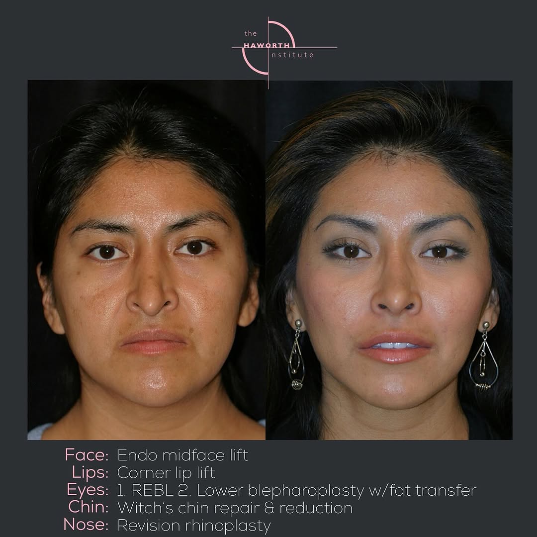 Instagram post by Dr. Randal Haworth: What do you think of her transformation ? Transform with us at : 🪩 www.DrHaworth.com 📞 +1(310)273-3000 📧 info@drhaworth.com