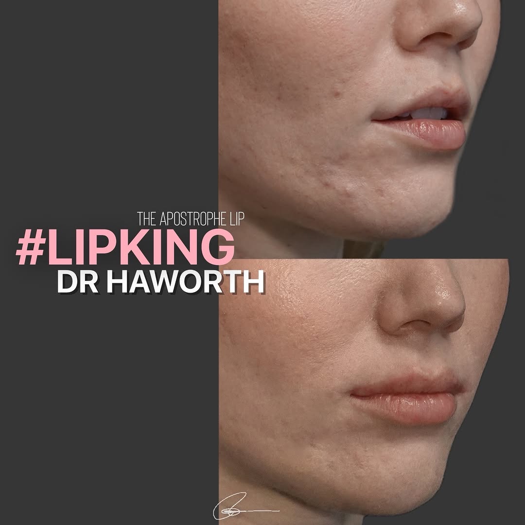 Instagram post by Dr. Randal Haworth: The apostrophe lip 👄 . I first describe this in my textbook chapter of the well regarded textbook for Plastic Surgeons “ Aesthetic Surgery …