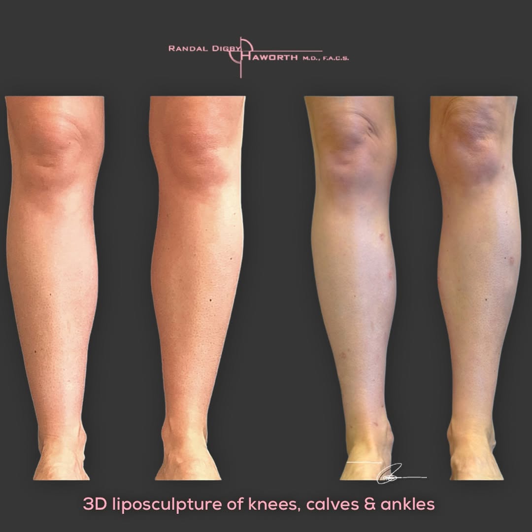 Instagram post by Dr. Randal Haworth: Your legs don’t have to look the same from the knee down. 🦵 One of the most overlooked areas of body sculpting is the lower leg. Strategic …
