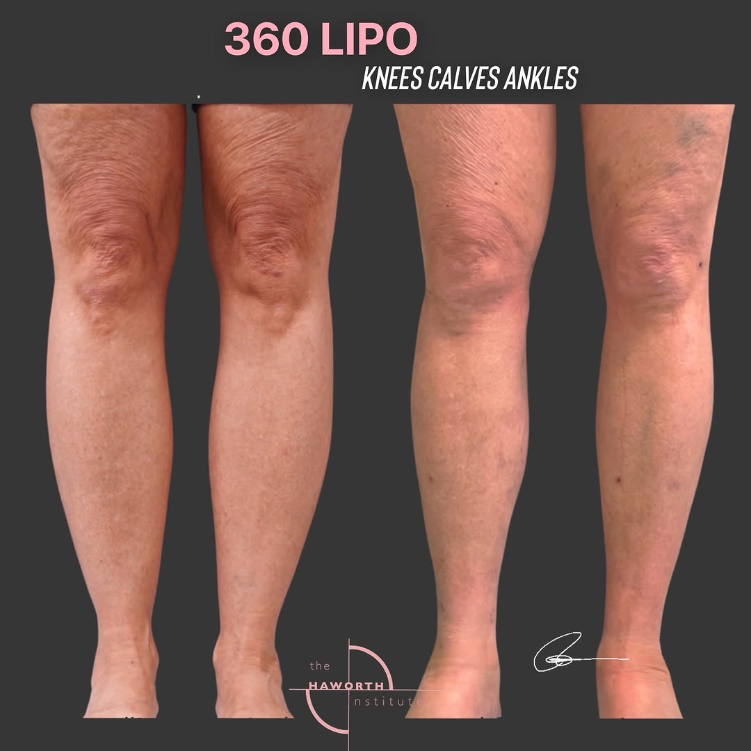 Instagram post by Dr. Randal Haworth: Your lower legs may be more sculptable than you think. Liposculpture isn’t limited to the abdomen, hips, or upper thighs. For carefully sele…