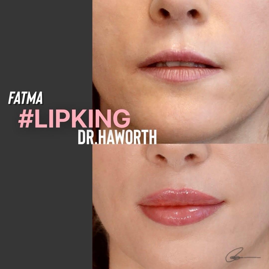 Instagram post by Dr. Randal Haworth: This European patient has INVERTED LIPS 👄 and no matter how much filler sessions she endured she would end up with duck 🦆 lips. She wanted…