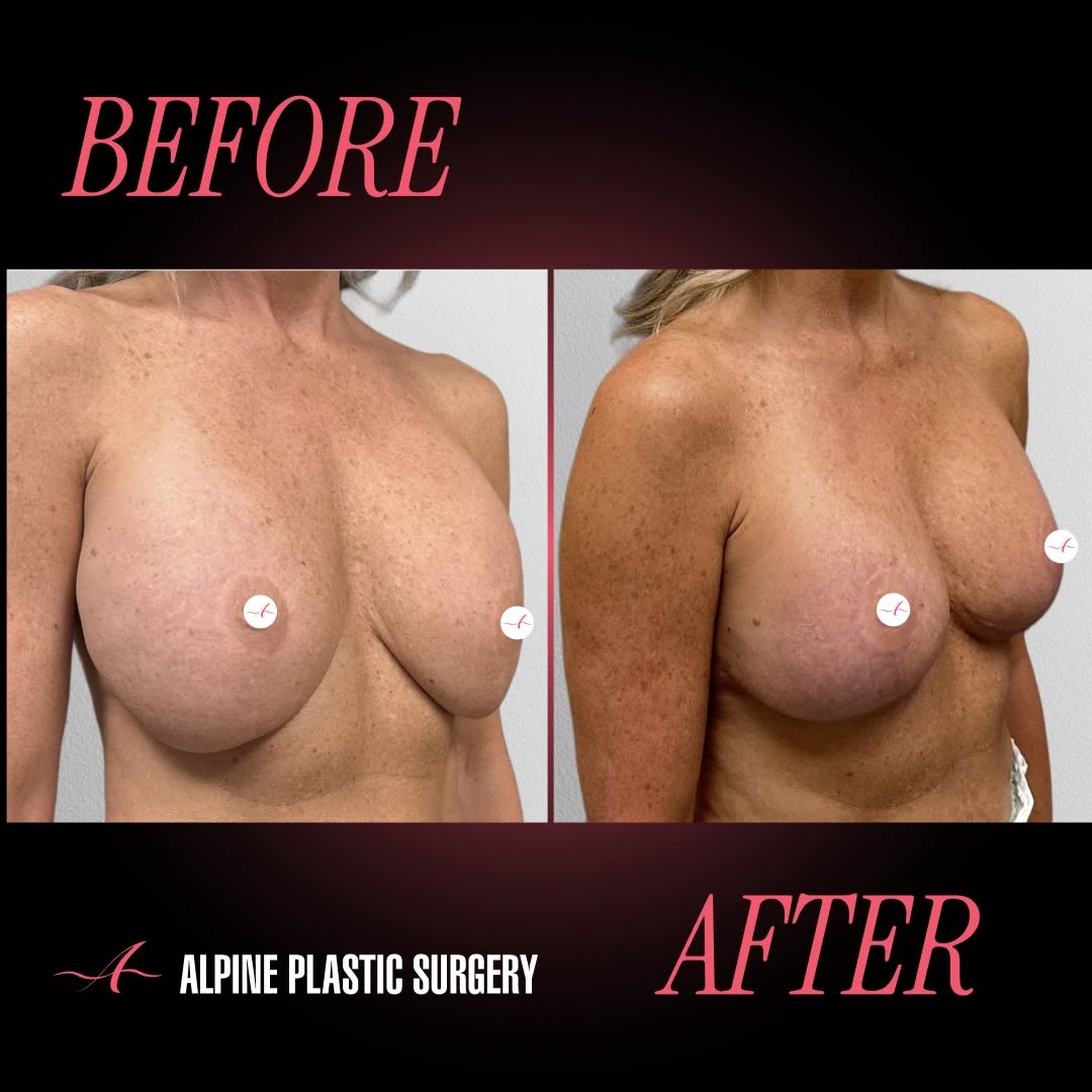 Instagram post by Dr. Randall D. Barnett: Breast Reaugmentation + Lift by @randallbarnettmd – 4 Months Post-Op 💖 Our beautiful 57-year-old patient is 4 months post breast reaugmenta…