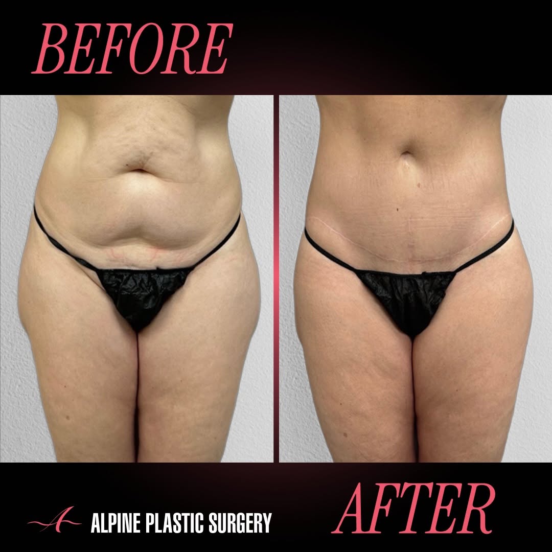 Instagram post by Dr. Randall D. Barnett: Extended Scar Tummy Tuck + Liposuction by @randallbarnettmd – 15 Months Post-Op Our 56-year-old patient is now 15 months post extended scar …