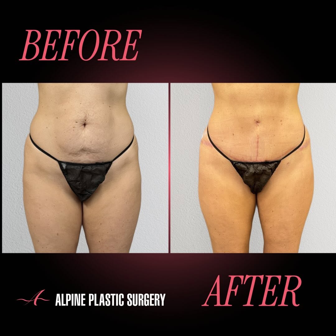 Instagram post by Dr. Randall D. Barnett: Abdominoplasty with Liposuction by @randallbarnettmd – 4 Months Post-Op After having three kids, this beautiful 40-year-old patient felt fru…