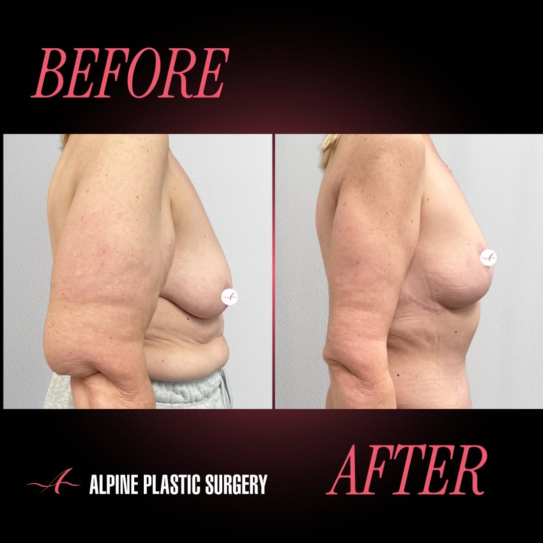 Instagram post by Dr. Randall D. Barnett: Brachioplasty by @randallbarnettmd – 5 Months Post-Op After losing over 100 pounds, this beautiful 58-year-old patient was ready for the nex…