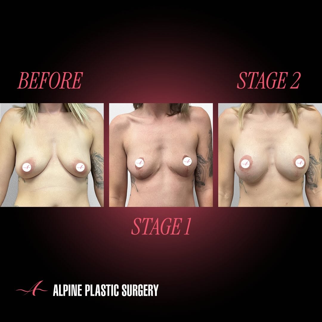 Instagram post by Dr. Randall D. Barnett: 2 Stage Breast Augmentation by @randallbarnettmd – 2 Years Post-Op Our beautiful 34-year-old patient underwent a two-stage breast augmentati…