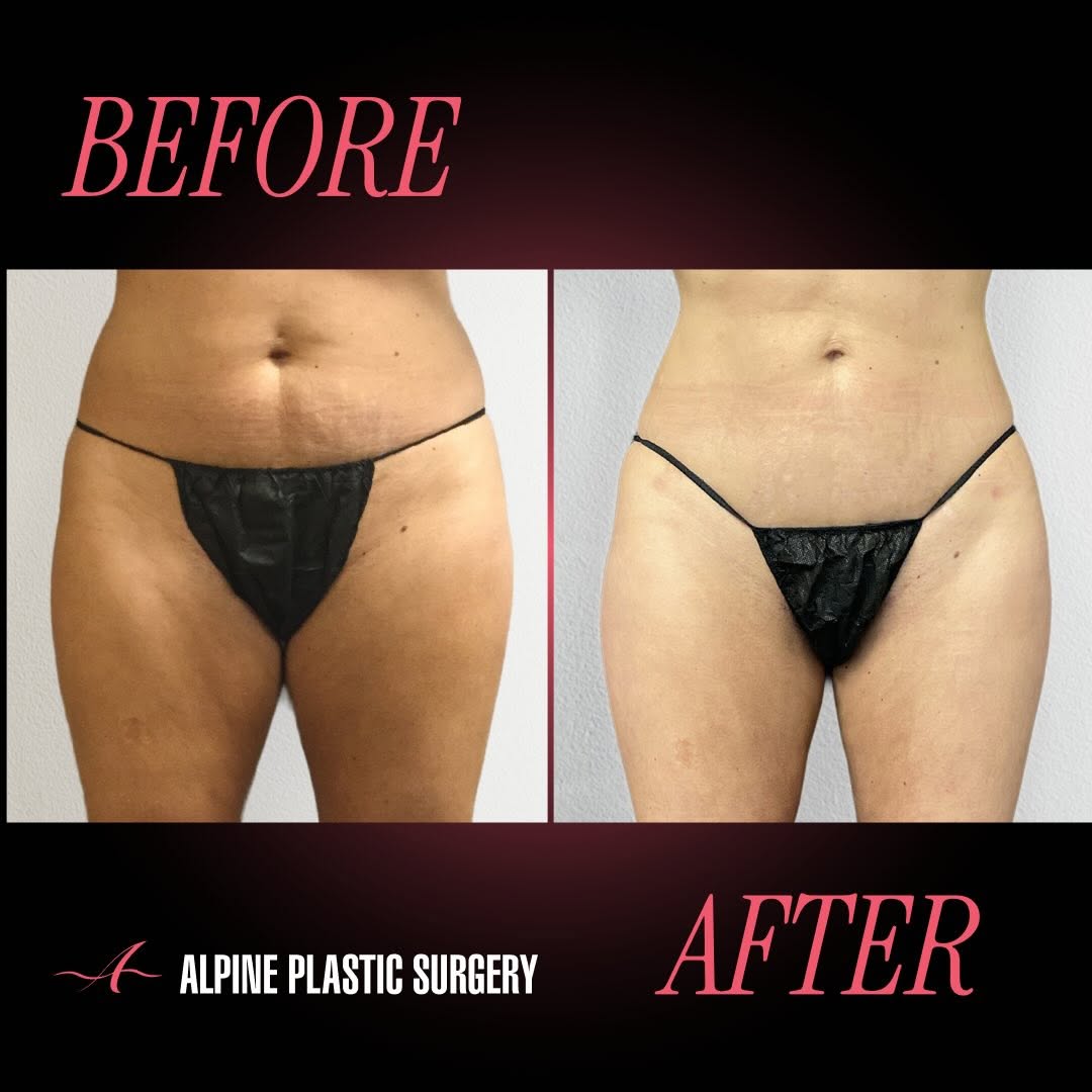 Instagram post by Dr. Randall D. Barnett: Liposuction by @randallbarnettmd – 3 Months Post-Op ✨ This 49-year-old patient is 3 months post liposuction to the abdomen, flanks, and inne…