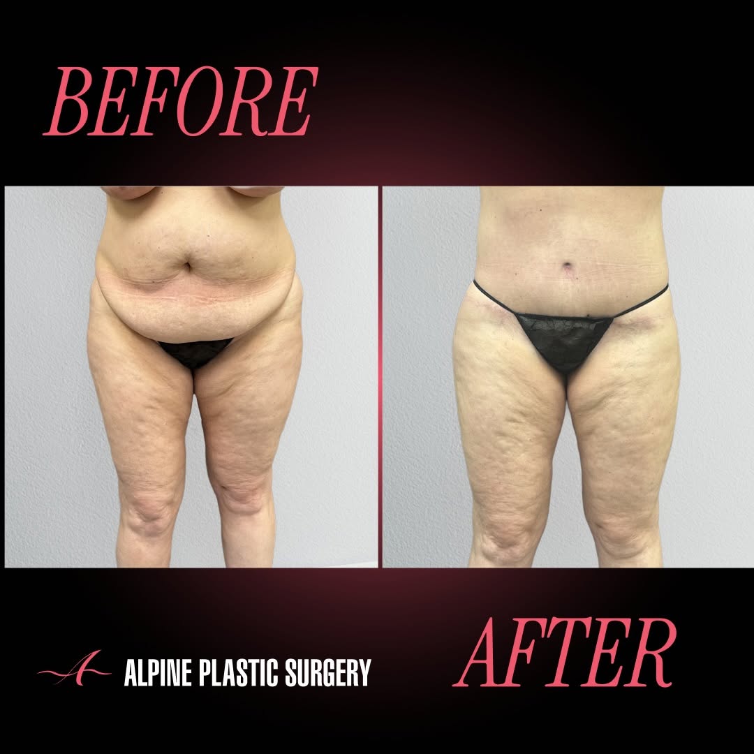 Instagram post by Dr. Randall D. Barnett: Extended Scar Abdominoplasty with Liposuction by @randallbarnettmd – 7 Months Post-Op Our beautiful 51-year-old patient is 7 months post ext…