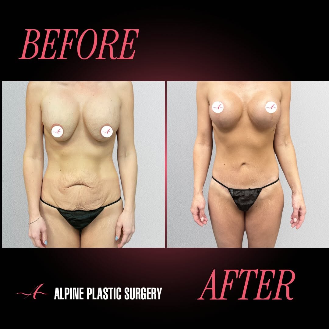 Instagram post by Dr. Randall D. Barnett: Mommy Makeover by @randallbarnettmd – 1 Year Post-Op Our beautiful 38-year-old patient is 1 year post mommy makeover, and is thrilled with h…