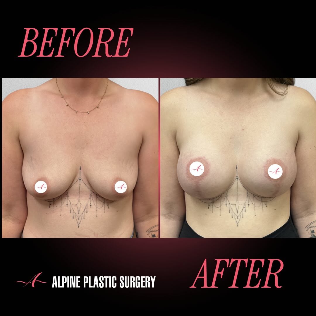 Instagram post by Dr. Randall D. Barnett: Breast Augmentation with Inverted “T” Lift by @randallbarnettmd – 6 Months Post-Op 💖 Our beautiful 27-year-old patient is 6 months post bre…