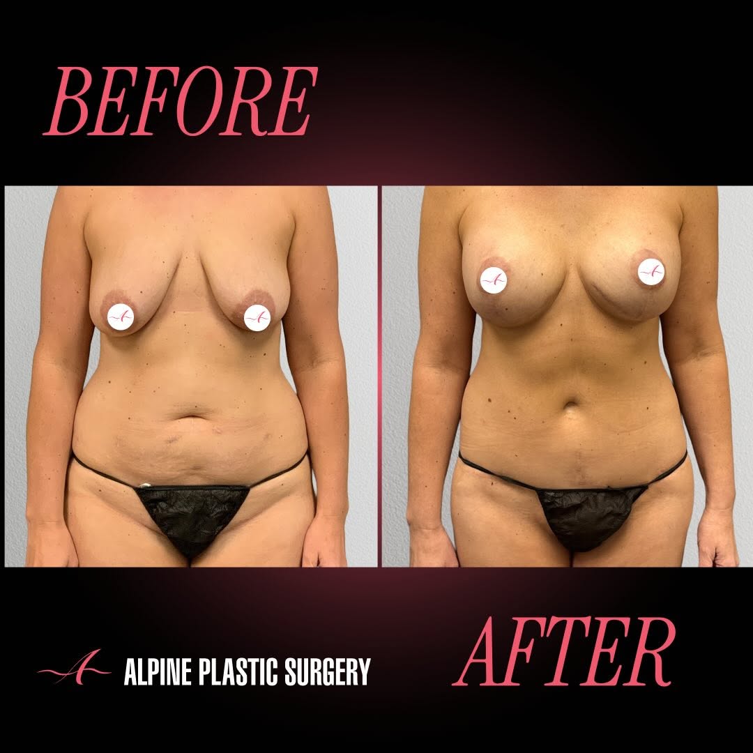 Instagram post by Dr. Randall D. Barnett: Mommy Makeover by @randallbarnettmd – 1 Year Post-Op Our beautiful 42-year-old patient is one year post Mommy Makeover and loving her transf…