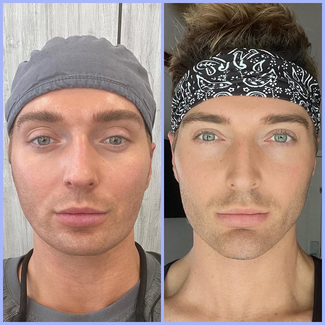 Instagram post by Dr. Randy Lindgren: Nonsurgical facial balancing and chin enhancement with no downtime. This patient traveled to see us for facial balancing with dermal fillers…