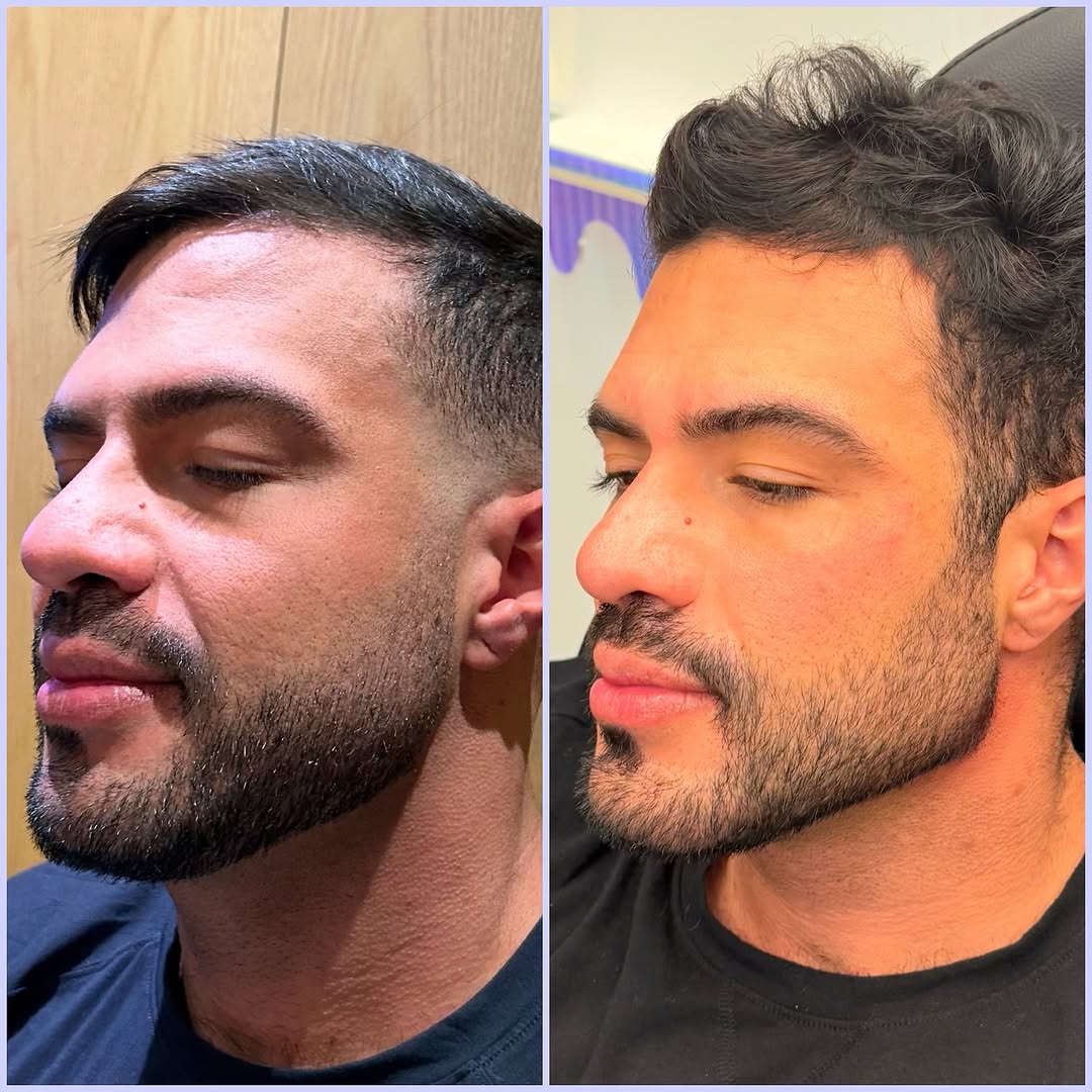 Instagram post by Dr. Randy Lindgren: Facial balancing with jawline and chin enhancement, botox and PRF ezGEL undereye rejuvenation. Facial balancing with jawline and chin enhanc…