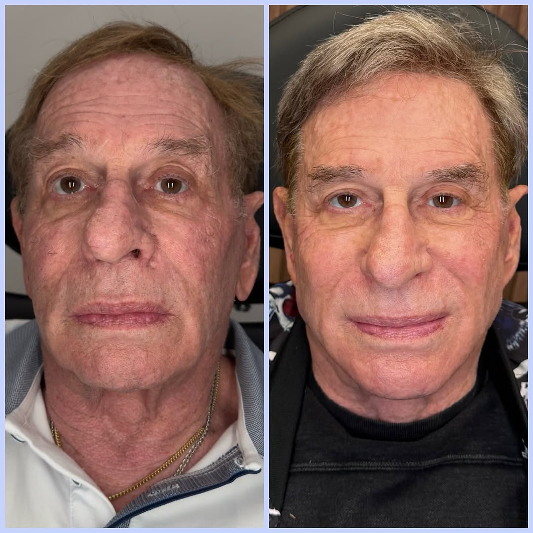 Instagram post by Dr. Randy Lindgren: No surgery, no downstime. A refreshed, lifted, and revitalized result — six months after his nonsurgical facelift procedure. This patient un…