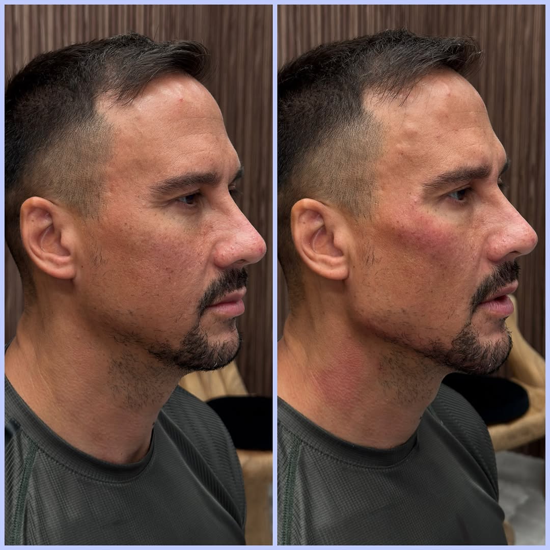 Instagram post by Dr. Randy Lindgren: Facial balancing with cheekbone, jawline and chin enhancement. This patient underwent a custom combination of cheekbone, jawline and chin fi…