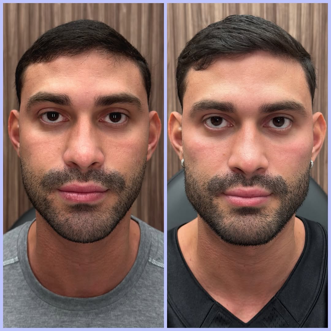 Instagram post by Dr. Randy Lindgren: Facial balancing isn’t about making someone look different—it’s about creating better structure, proportion, and support. For this patient, …