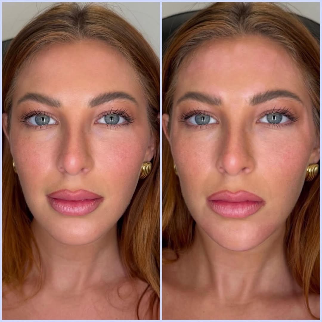 Instagram post by Dr. Randy Lindgren: Facial balancing for the skin expert of south florida @myskindealer She wanted a tighter, more sculpted lower face while keeping everything …