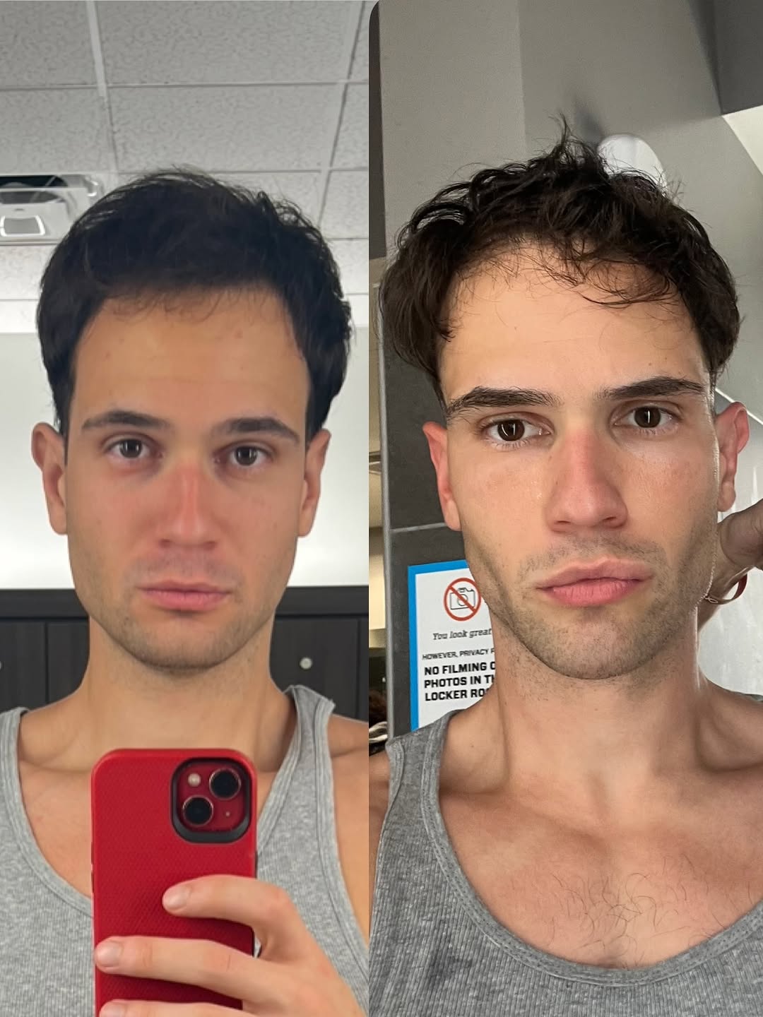 Instagram post by Dr. Randy Lindgren: 26 male, hyaluronic acid-based dermal filler and arriessence PDGF before after. When choosing a provider I made sure not to cheap out and di…